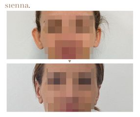 Korekcja uszu - Klinika Sienna