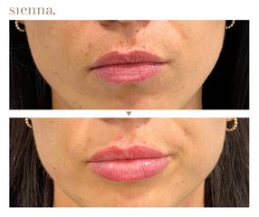 Powiększanie ust - Klinika Sienna