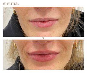 Powiększanie ust - Klinika Sienna