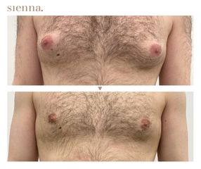 Ginekomastaia - Klinika Sienna