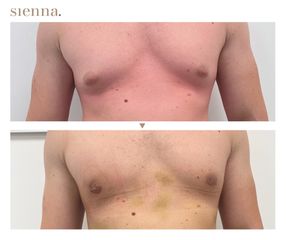 Ginekomastaia - Klinika Sienna