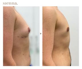 Ginekomastaia - Klinika Sienna