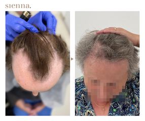 Przeszczep włosów - Klinika Sienna