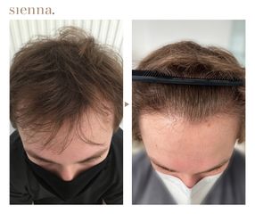 Przeszczep włosów - Klinika Sienna