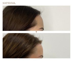 Lifting twarzy - Klinika Sienna