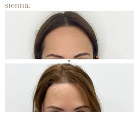 Lifting twarzy - Klinika Sienna
