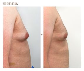 Ginekomastia - Klinika Sienna