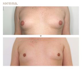 Ginekomastia - Klinika Sienna