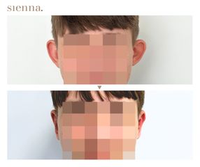 Korekcja uszu - Klinika Sienna