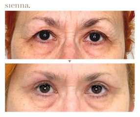 Blefaroplastyka - Klinika Sienna
