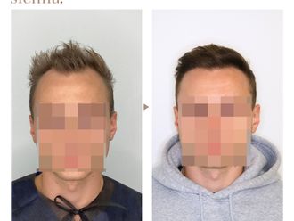 Przeszczep włosów przed i po - 859973