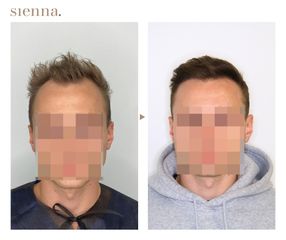 Przeszczep włosów FUE - Klinika Sienna