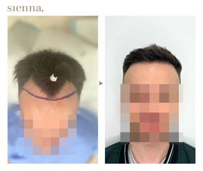 Przeszczep włosów FUE - Klinika Sienna