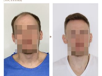 Przeszczep włosów przed i po - 859975