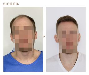 Przeszczep włosów FUE - Klinika Sienna