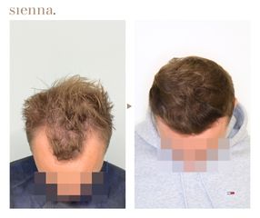 Przeszczep włosów FUE - Klinika Sienna