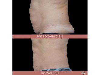 Liposukcja nieinwazyjna przed i po - 685909