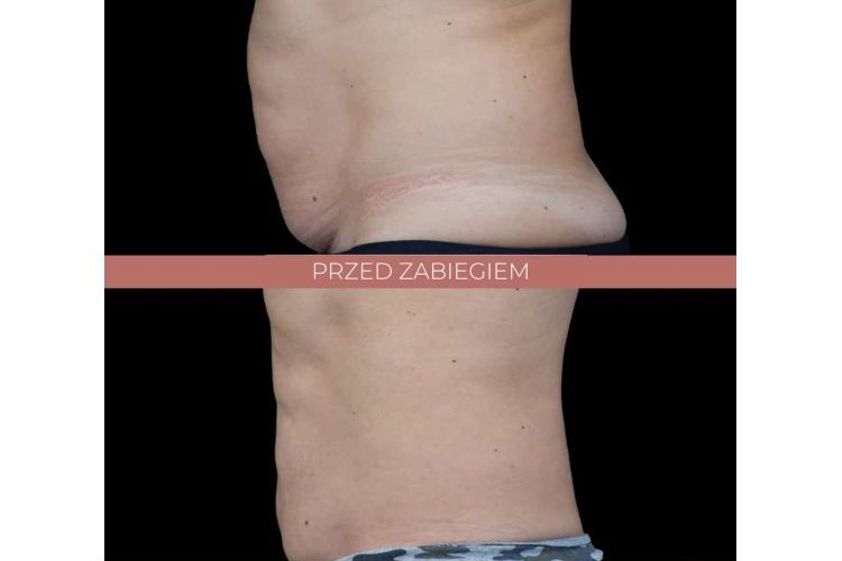 Liposukcja nieinwazyjna przed i po - 685909