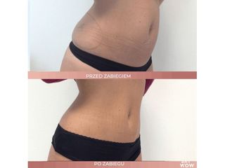 Coolsculpting, czyli odchudzanie przez zamrażanie - przed i po