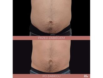 Liposukcja nieinwazyjna przed i po - 685913