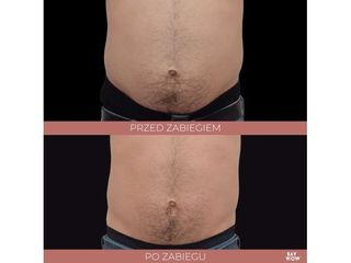 BTL Emsculpt - brzuch: przed i po