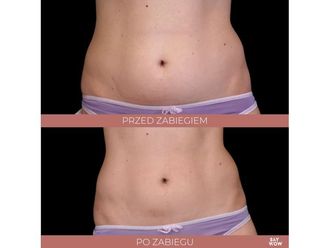 Liposukcja nieinwazyjna przed i po - 685914
