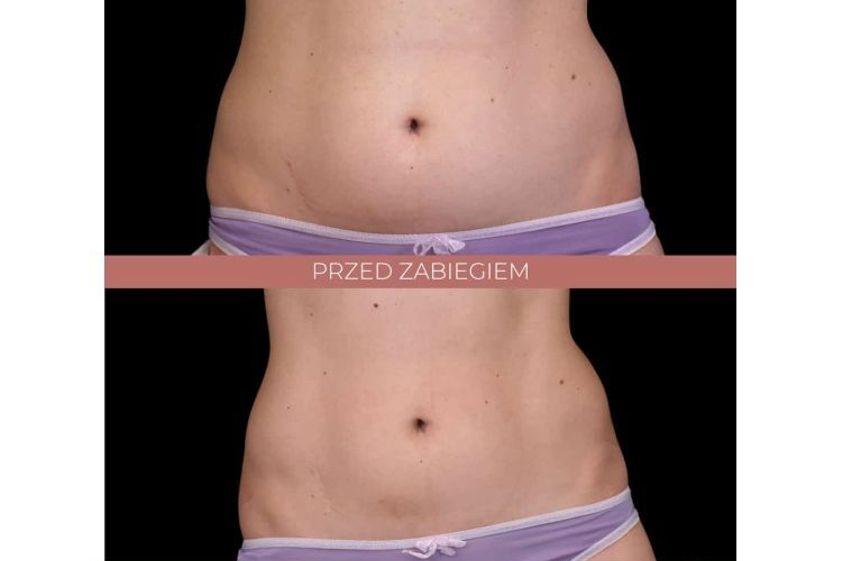 Liposukcja nieinwazyjna przed i po - 685914