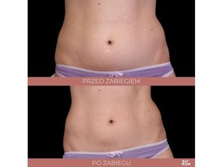 BTL Emsculpt na brzuch - przed i po