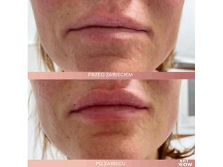 Kwas hialuronowy do wypełniania ust - przed i po