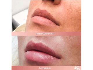 Kwas hialuronowy do nawilżania ust - przed i po