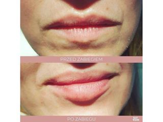 Nawilżanie ust kwas hialuronowym - przed i po