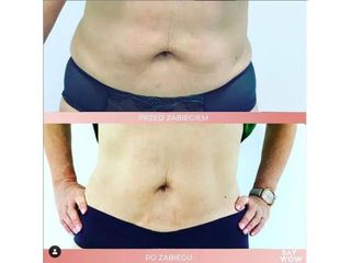 CoolsSculpting, BTL Emsculpt, fala uderzeniowa - przed i po