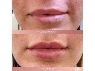 Modelowanie ust kwasem hialuronowym - przed i po
