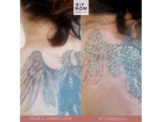 Usuwanie tatuażu laserem - przed i po