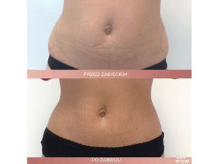 CoolSculpting, kriolipoliza brzucha - przed i po