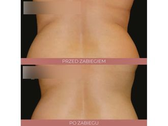 Kriolipoliza przed i po - 842797