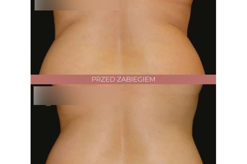 Kriolipoliza przed i po - 842797