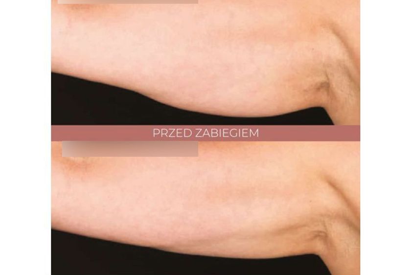 Kriolipoliza przed i po - 842798