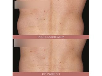 Kriolipoliza przed i po - 842799