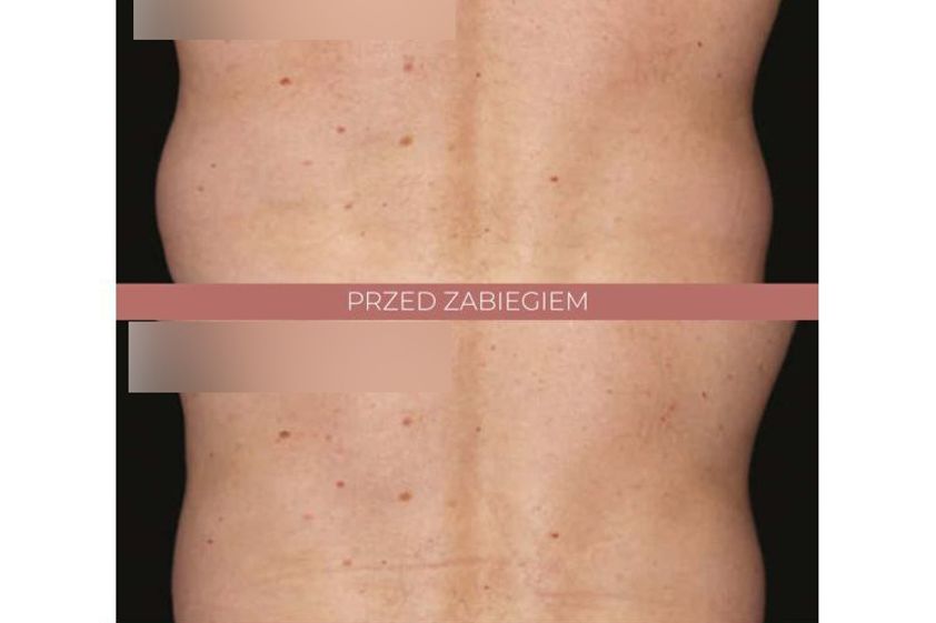 Kriolipoliza przed i po - 842799