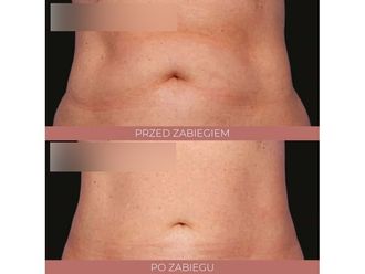 Kriolipoliza przed i po - 842800