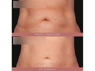 Kriolipoliza - Say WOW!