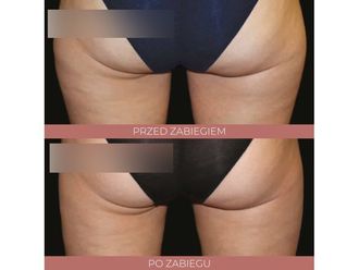 Kriolipoliza przed i po - 842801