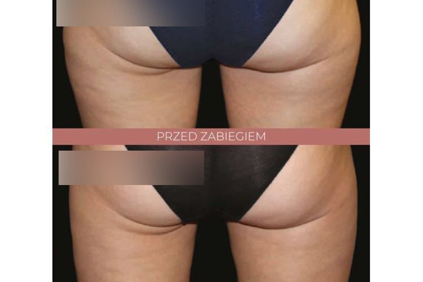 Kriolipoliza przed i po - 842801