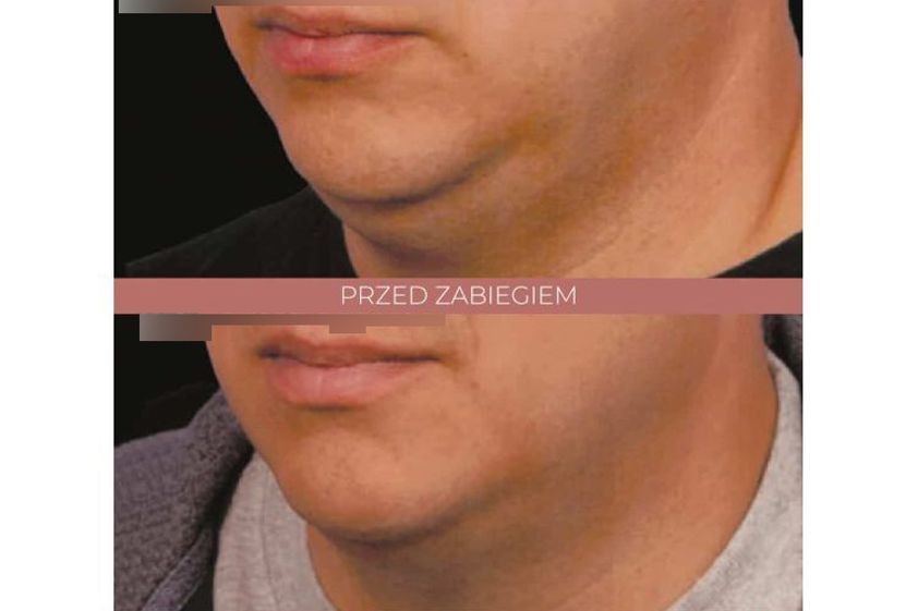 Kriolipoliza przed i po - 842802