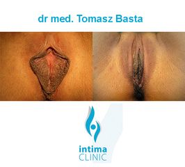 ff_labioplasty_tomasz_basta_2