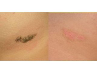 Przed i po: usunięcie zmiany skórnej