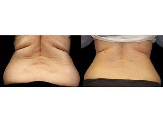 Przed i po: Exilis radiofrekwencja