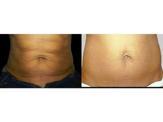 Przed i po: Exilis Elite PIC B&A