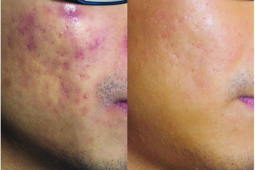 Laserowe zabiegi dermatologii estetycznej przed i po - 690942